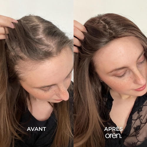 Témoignage avant/après Oren
