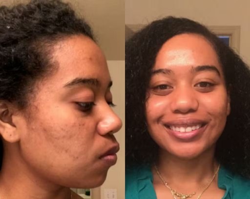 Before and after